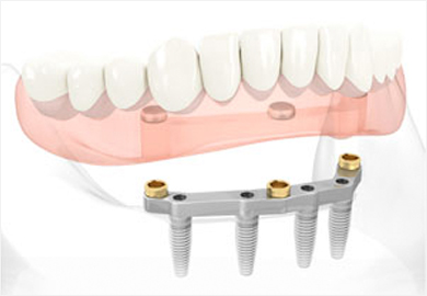 Dentier fixe sur implant - Dentier clipsé sur 4 implants 2925€ en 3 jours